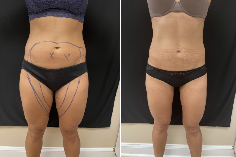 laser lipo dc